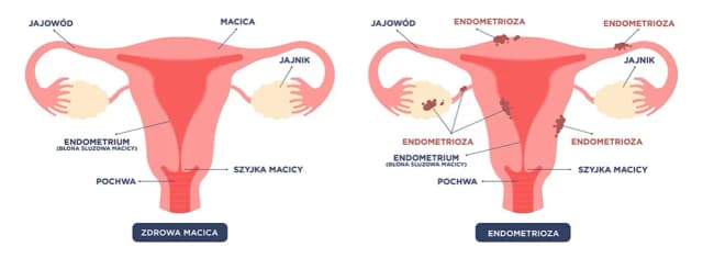 Przerost endometrium objawy: jak rozpoznać i co robić, gdy je zauważysz