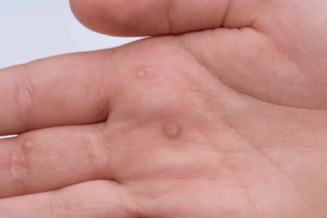 Skąd się biorą kurzajki? Przyczyny, objawy i jak uniknąć zakażenia HPV