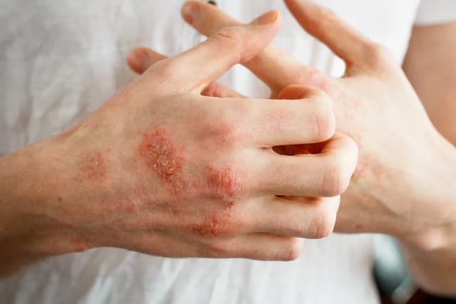Objawy alergii kontaktowej: Jak je rozpoznać i uniknąć problemów