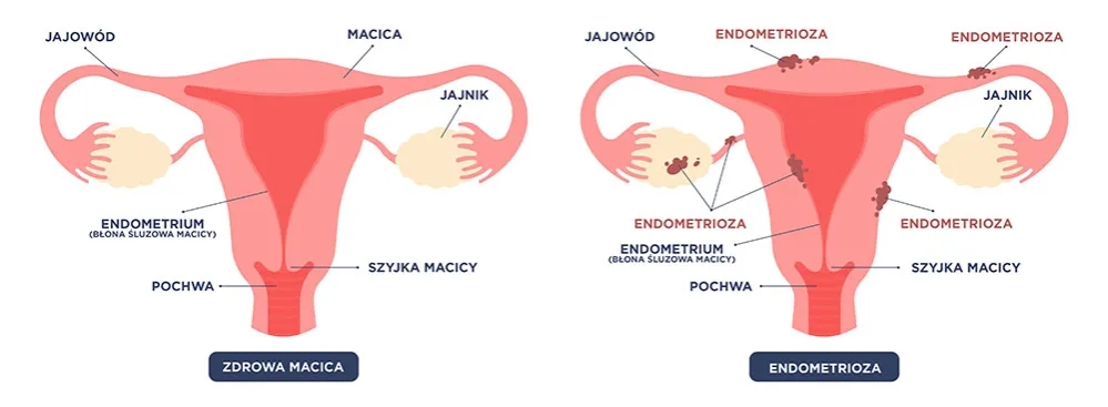 Przerost endometrium objawy: jak rozpoznać i co robić, gdy je zauważysz