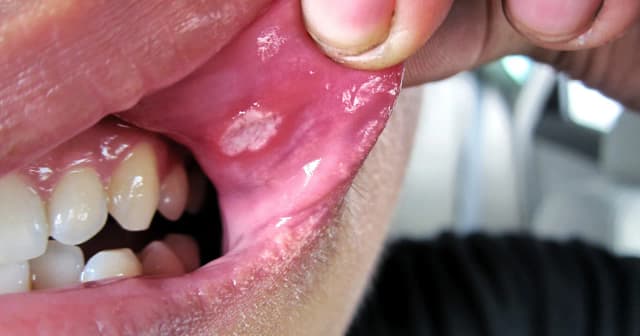 Skąd się biorą afty? Poznaj przyczyny i skuteczne sposoby zapobiegania Skąd się biorą afty? Poznaj przyczyny i skuteczne sposoby zapobiegania