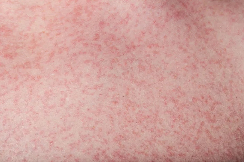 Alergia na słońce objawy: Jak rozpoznać i uniknąć nieprzyjemności