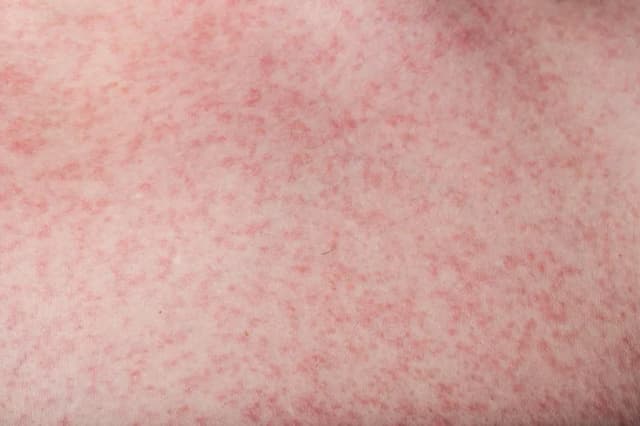Alergia na słońce objawy: Jak rozpoznać i uniknąć nieprzyjemności