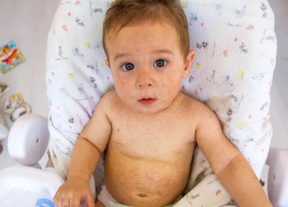 Alergia pokarmowa: objawy, które mogą zaskoczyć i zaniepokoić