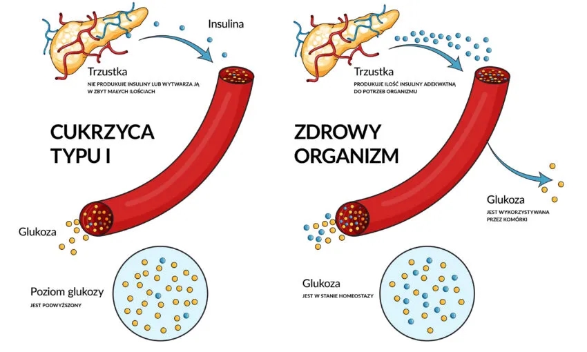 Skąd się bierze cukrzyca? Poznaj główne przyczyny i jak ich uniknąć