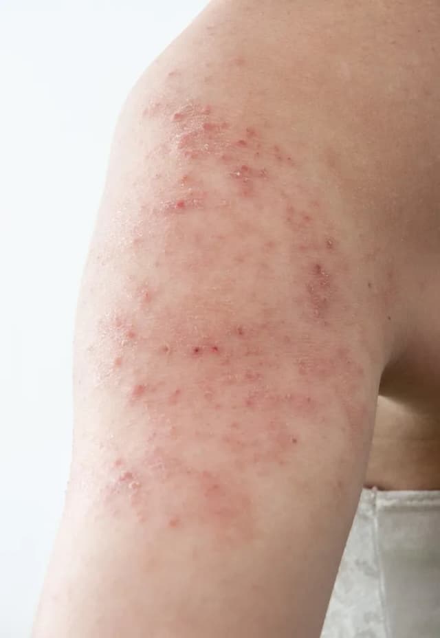Alergia objawy skórne: Jak rozpoznać i unikać nieprzyjemnych skutków